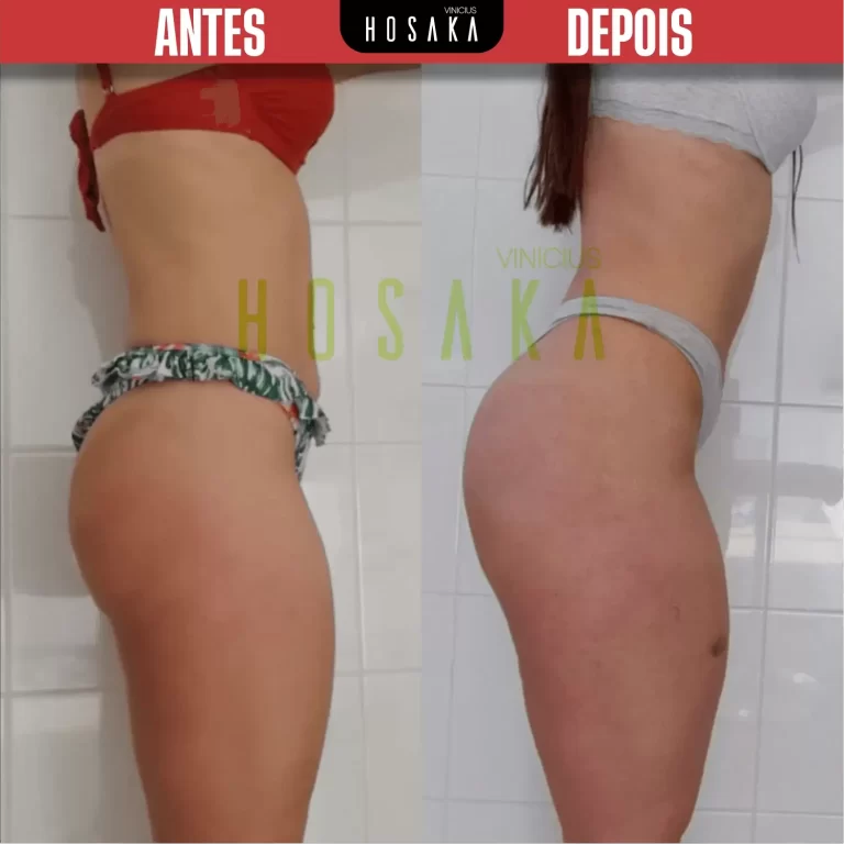 ANTES-E-DEPOIS-07