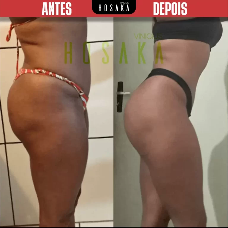 ANTES-E-DEPOIS-13