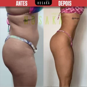 ANTES-E-DEPOIS-17